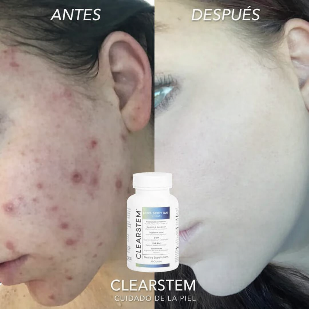 50%OFF- MINDBODYSKIN®: Suplemento Natural Antiacné que Equilibra Hormonas, Mejora la Digestión y Desintoxica la Piel desde Adentro.