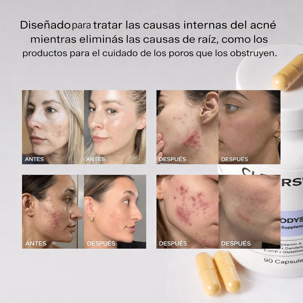 50%OFF- MINDBODYSKIN®: Suplemento Natural Antiacné que Equilibra Hormonas, Mejora la Digestión y Desintoxica la Piel desde Adentro.